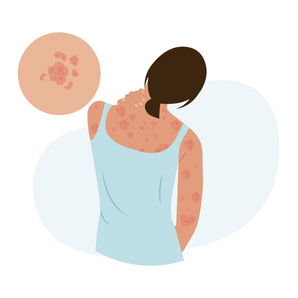 Psoriasis and Eczema
