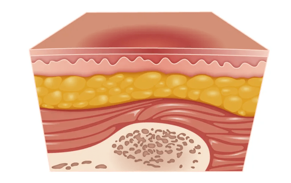 Skin Ulcer(bedsore) Stages: How It Ruins Your Skin