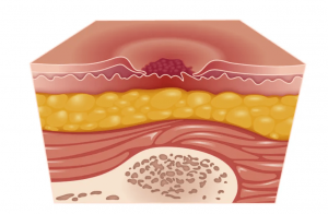 Skin Ulcer(Bedsore) Stages: How It Ruins Your Skin - Voibon Blog