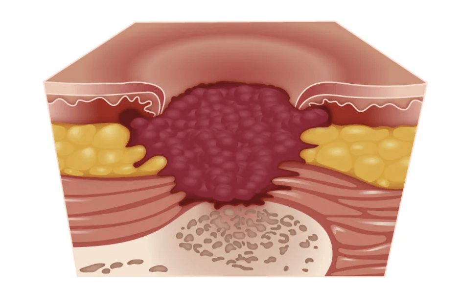 Skin Ulcer(bedsore) Stages: How It Ruins Your Skin