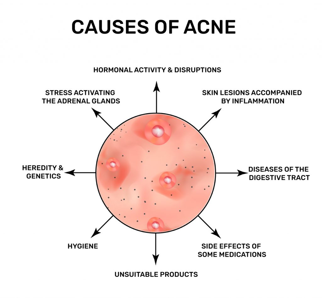 Factors You Don't Know that Cause Acne - Voibon Blog