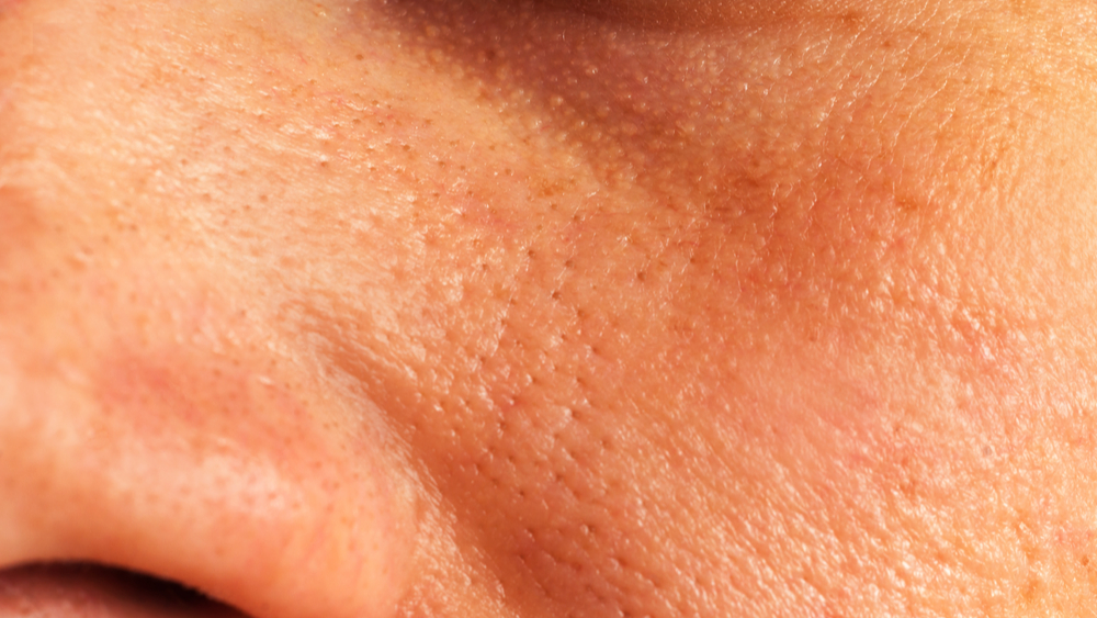 4 Types Of Pores Found In The Face