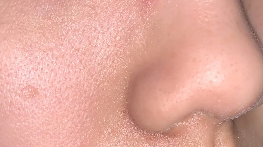 Oily Pores