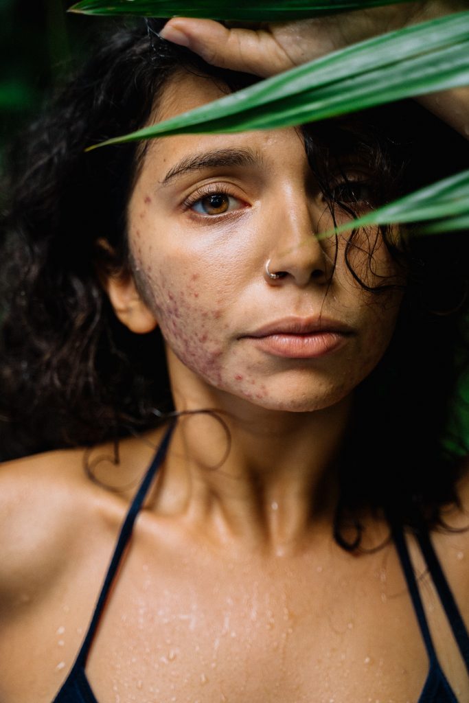 What Should You Know About Inflamed Acne?