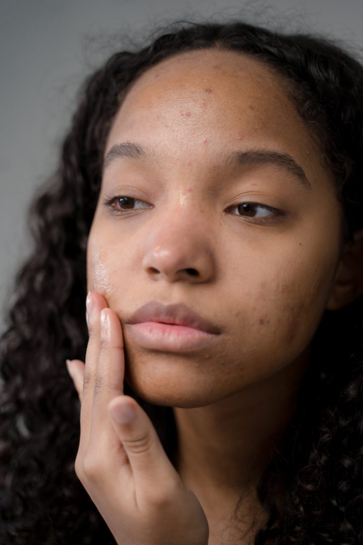 What Should You Know About Inflamed Acne?