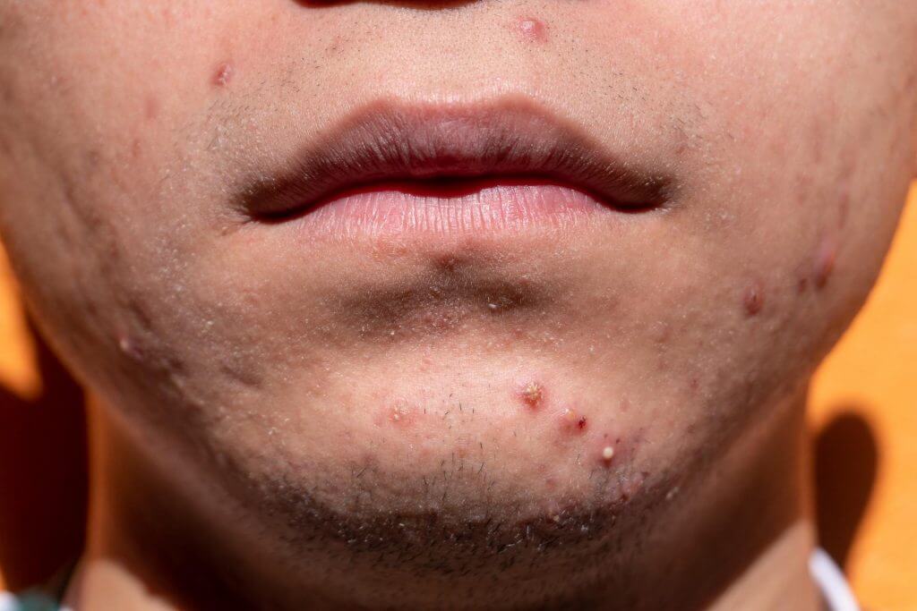 Why Do You Suddenly Get Acne In The Late 20s?
