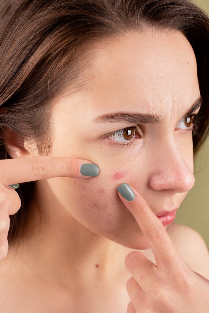 What Causes Polycystic Ovary Syndrome(pcos) Acne And How To Treat Them?