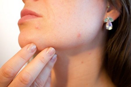 Taking Spironolactone For Acne? Here Is Everything You Want To Know